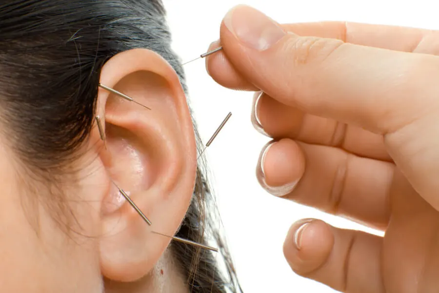 Ear acupuncture on the outer ear
