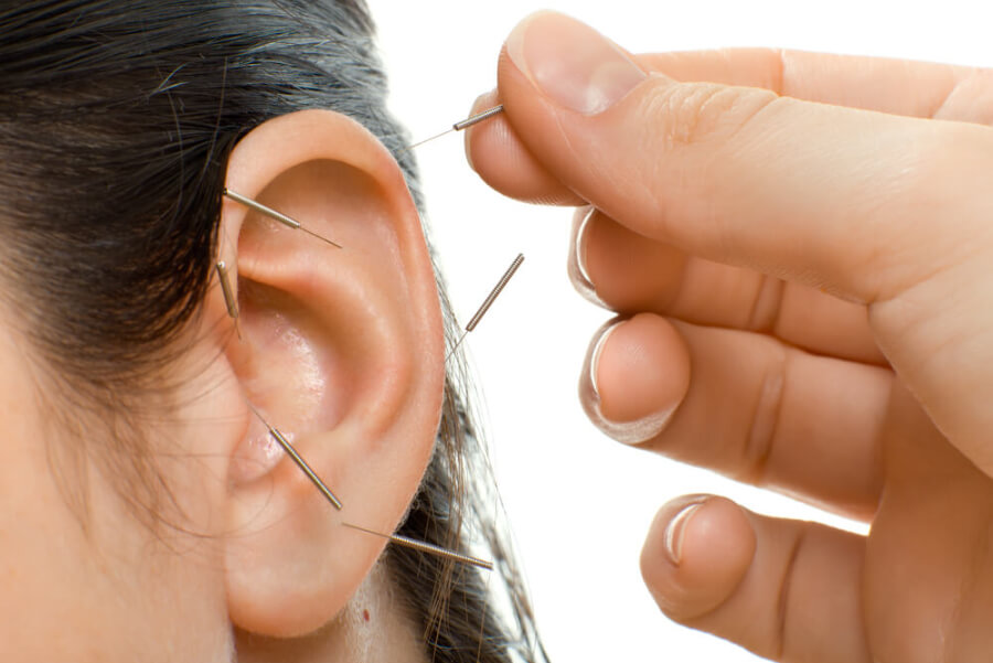 ear acupuncture lake forest